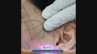 تزریق چربی - 02632402304