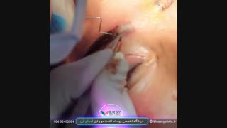 کاشت ابرو - 02632402304
