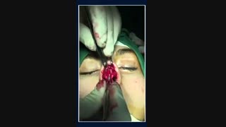 فیلم جراحی بینی