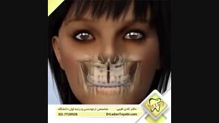 جراحی فک در ناهنجاری کراس بایت | دکتر طیبی