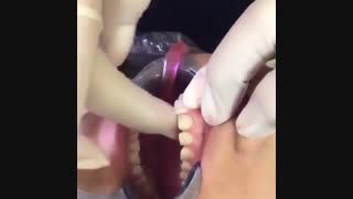 فیلم چسباندن لمینیت سرامیکی روی دندان