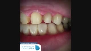 لمینیت سرامیکی با رنگ طبیعی