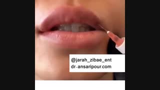 فیلم واقعی تزریق ژل درمان جای جوش