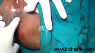 عمل جراحی شقاق مقعدی(فیشر)، بررسی عوارض و هزینه ها - بیچشک