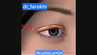 جراحی زیبایی پلک