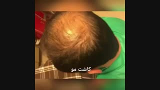 کاشت مو دکتر ابدالی - 22807060