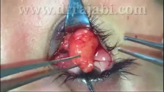 تخلیه توده های چربی تزریق شده