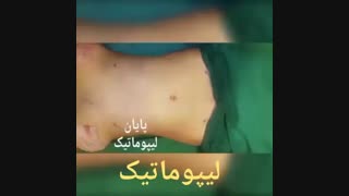 لیپوماتیک - دکتر ابدالی - 22807060