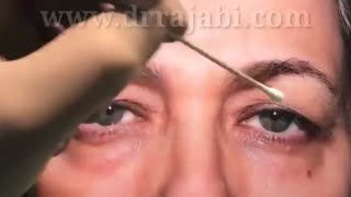 انتظارات جراحی بلفاروپلاستی یا برداشتن پف پلک