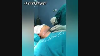 فیلم رفع غبغب با لیزر لیپولیز درمان جای جوش