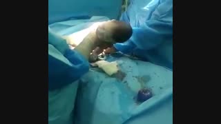 عمل سزارین آسان