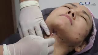 لیفت غبغب با نخ