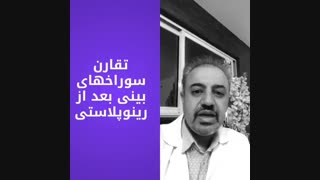 سوراخ های بینی متقارن بعد از عمل جراحی زیبایی