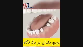 فیلم بریج دندان