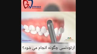 فیلم نحوه کارگذاشتن ارتودنسی دندان