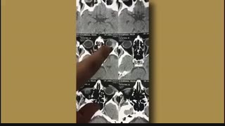 جراحی توده حدقه چشم