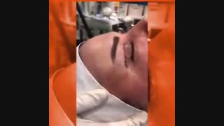 عمل جراحی بلفاروپلاستی