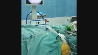 فیلم عمل آرتروسکوپی زانو 2