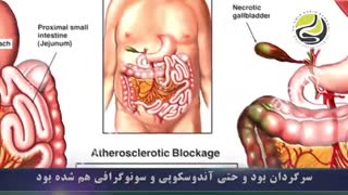 فیلم کولونوسکوپی به دلیل گرفتگی عروق  روده در آقای 45 ساله