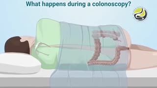 درحین و بعد از کولونوسکوپی چه اتفاقاتی می افتد؟
