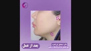 زاویه سازی صورت با تزریق چربی زیبایی پوست