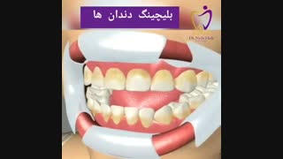 نحوه بلیچینگ دندان