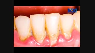 التهاب و خونریزی لثه دندانپزشکی کودکان