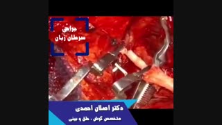 جراحی سرطان زبان