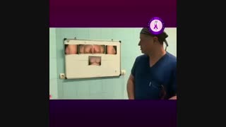 جراحی ژنیکوماستی شدید در ورزشکار حرفه ای