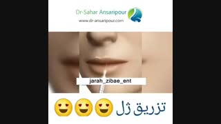 انیمیشن نحوه تزریق ژل