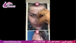 عمل زیبایی پلک و بینی