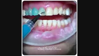 تعویض کامپوزیت ونیر با لمینیت سرامیکی | کلینیک دندانپزشکی ایده آل