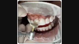 پالیش کامپوزیت ونیر | کلینیک دندانپزشکی ایده آل لیزر صورت