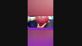 جراحی میومکتومی با حفظ رحم