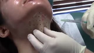 رفع غبغب با مزوتراپی Keybella