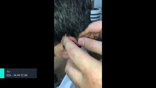 آموزش نحوه جایگذاری سمعک ریسور داخل کانال (RIE)