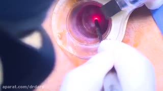 عمل جراحی بواسیر با اشعه لیزر