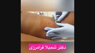 کربوکسی تراپی ماموپلاستی