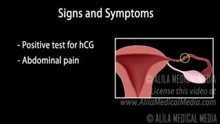 حاملگی خارج از رحم