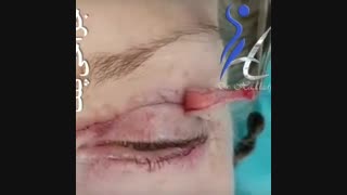 جراحه الجفن