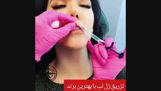 تزریق ژل لب