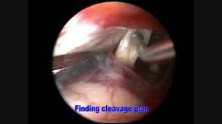 Endoscopic Vestibular Nerve Section - بیماری منییر
