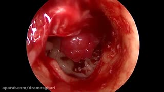 جراحی آندوسکوپیک گلوموس تیمپانیکوم