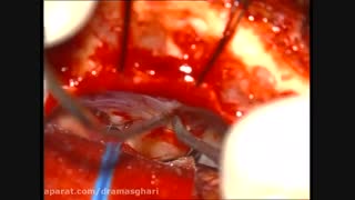 جراحی نورینوم آکوستیک چپ با حفظ شنوایی