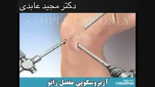 آرتروسکوپی مفصل زانو