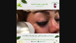 برطرف کردن خطوط پنجه کلاغی اطراف چشم - لیفت پلک بالا - کلینیک زیبایی آنا