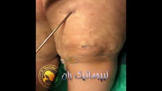 لیپوماتیک ران - دکتر ابدالی - 22807060