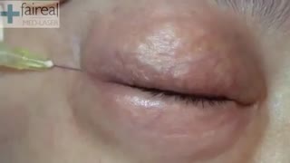 رفع تیرگی و چروک دور چشم با کربوکسی تراپی