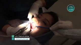 بلیچینگ یا سفید کردن دندان