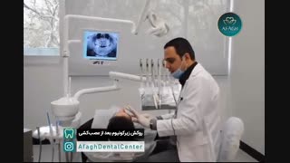 روکش زیرکونیا دندان